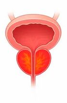 Infiammazione della ghiandola prostatica